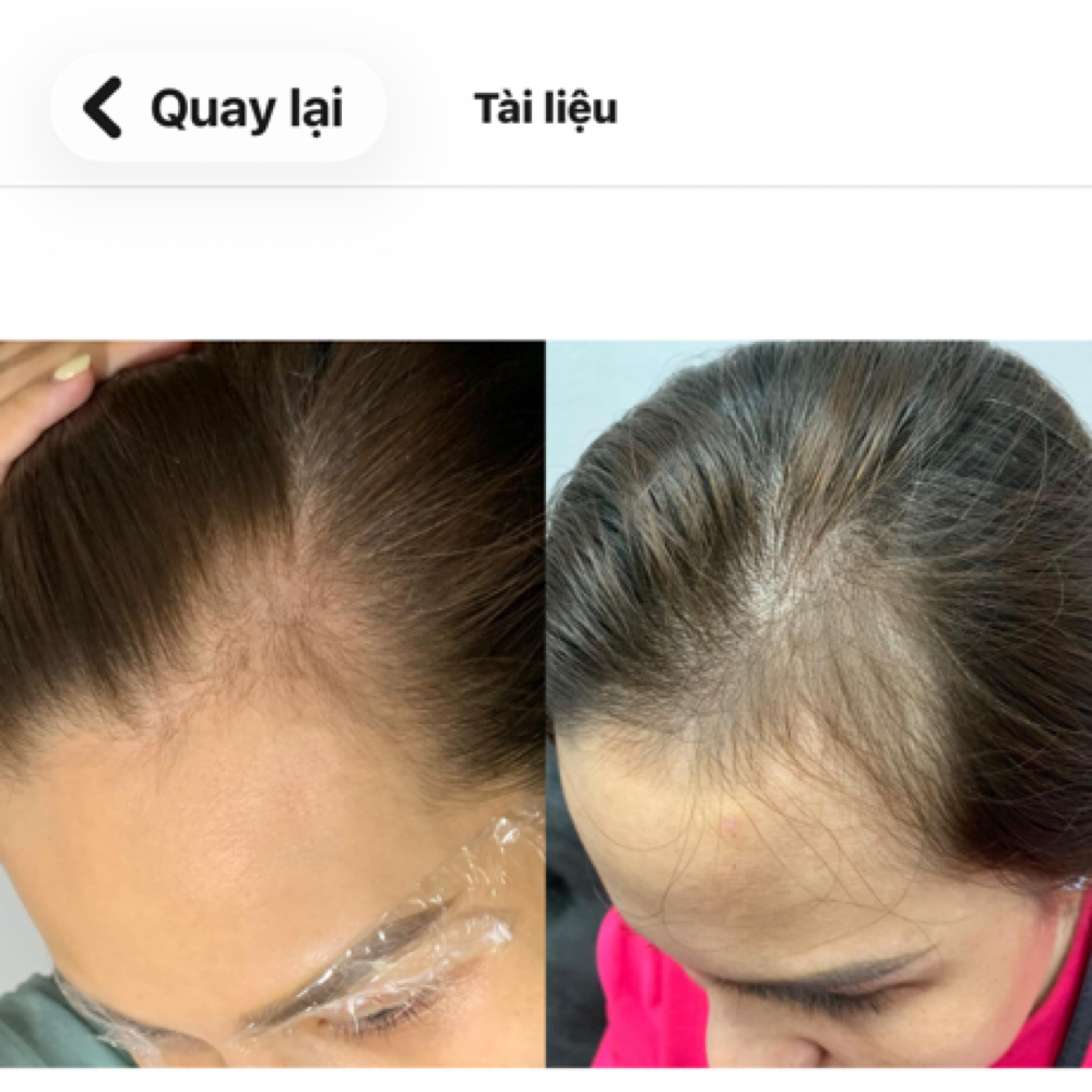 Scalp Needling Hair Growth Serum at Excellent Nails By Sandy in California, CA
