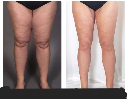4 TRETMENT THIGHS REDUCTION