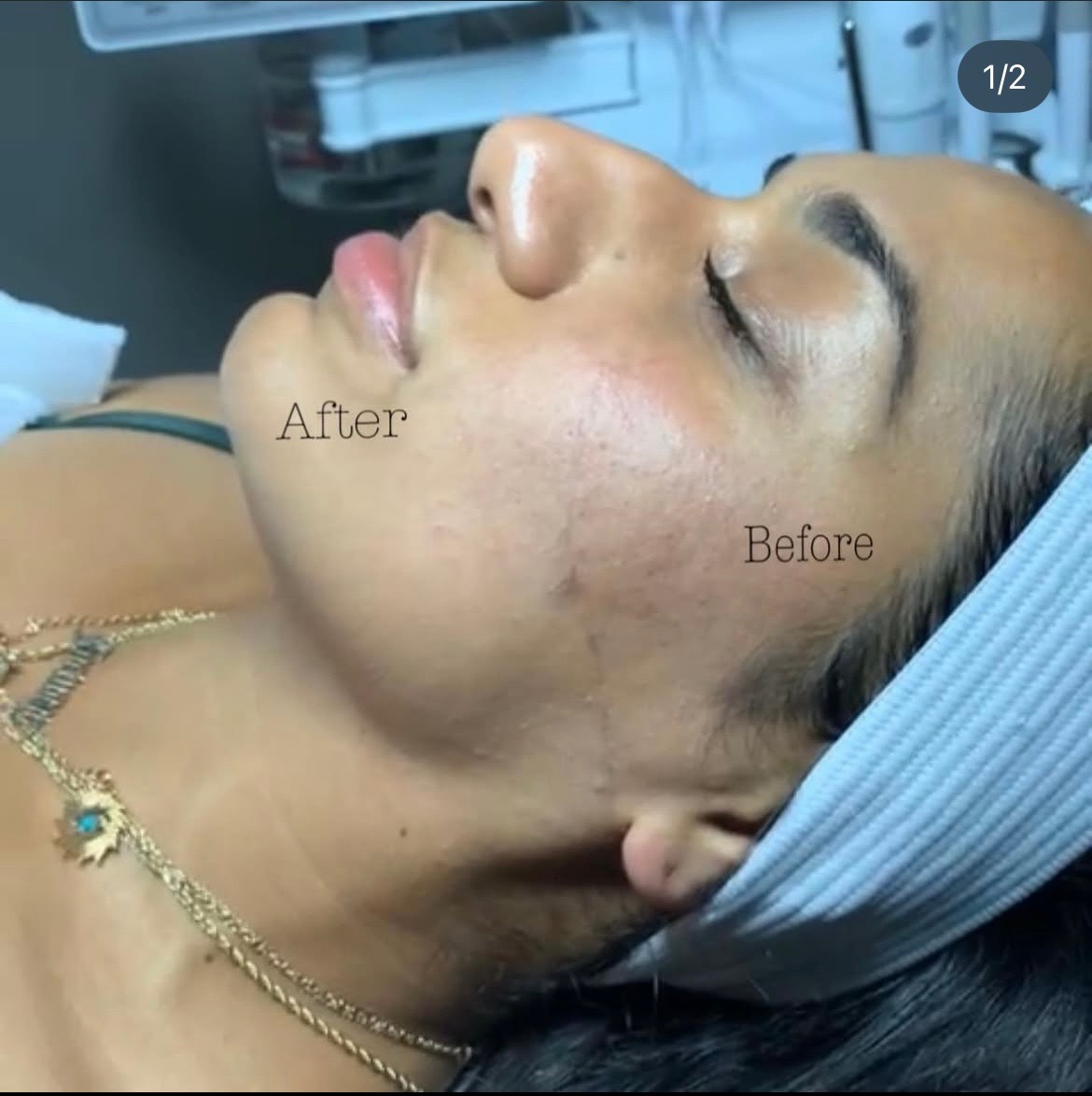 Dermaplaning