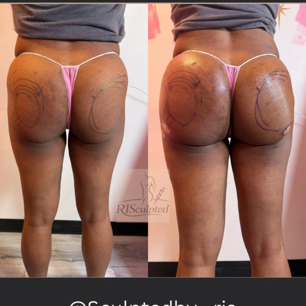 The “Mini” Doll (300ml) at RISculpted Aesthetics in Stockbridge, GA