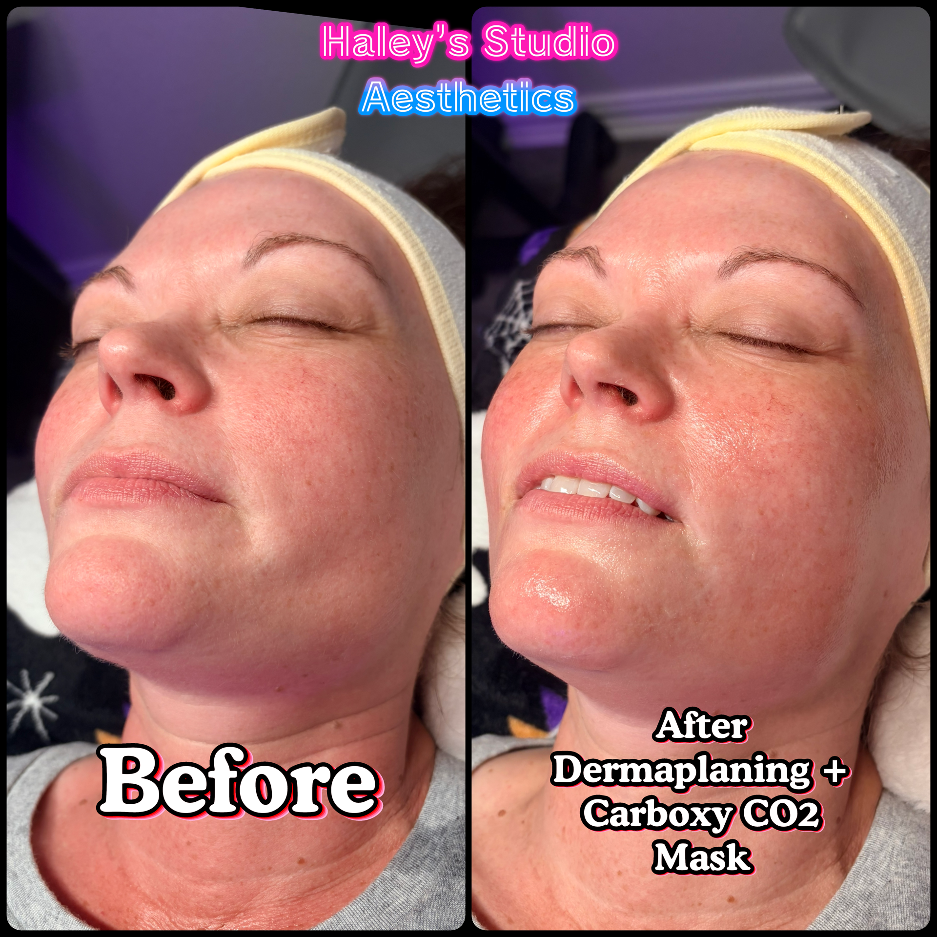 CO2 Mask Skin Therapy