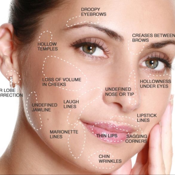 Cosmetic Fillers at A Better You Viewpoint in Prescott Valley, AZ