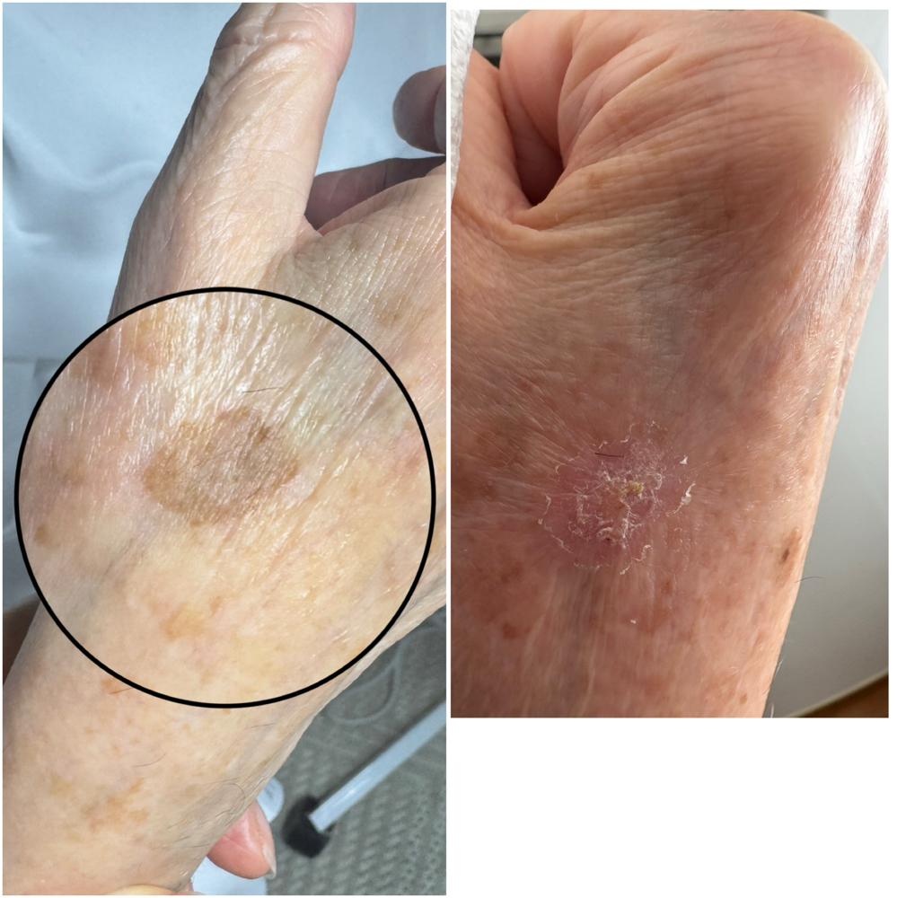 mole & Brown Spot remove