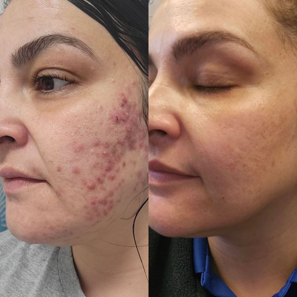 ACNE PROGRAM RETURNING CLIENT at CYNC Beauty in Long Beach, CA