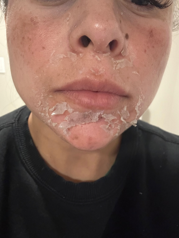 Golden Glow Peel