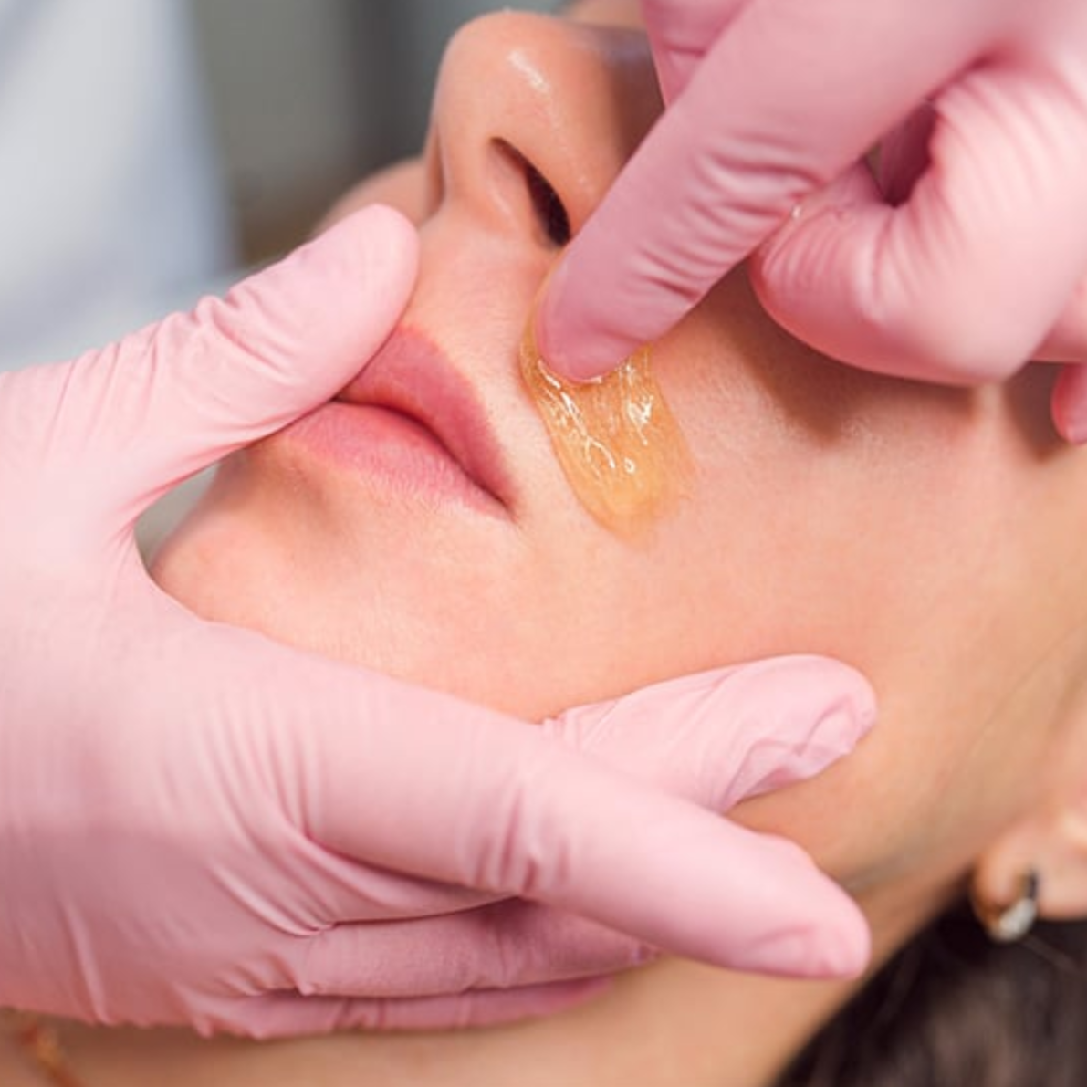 Upper Lip at Luxe Skin x Abby in Edgewood, TX