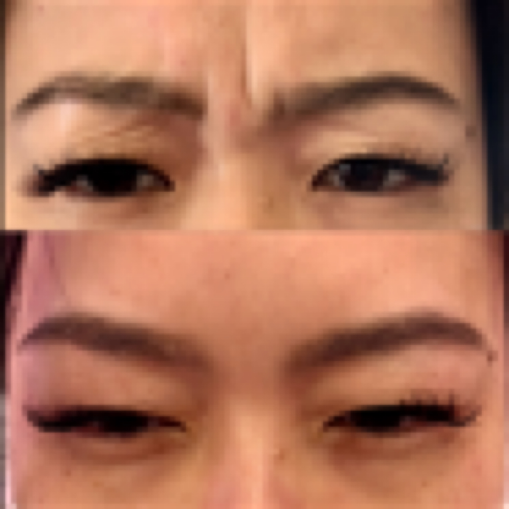 Wrinkle Relaxer $14/unit at Dallas Aesthetic Studio in Dallas, TX