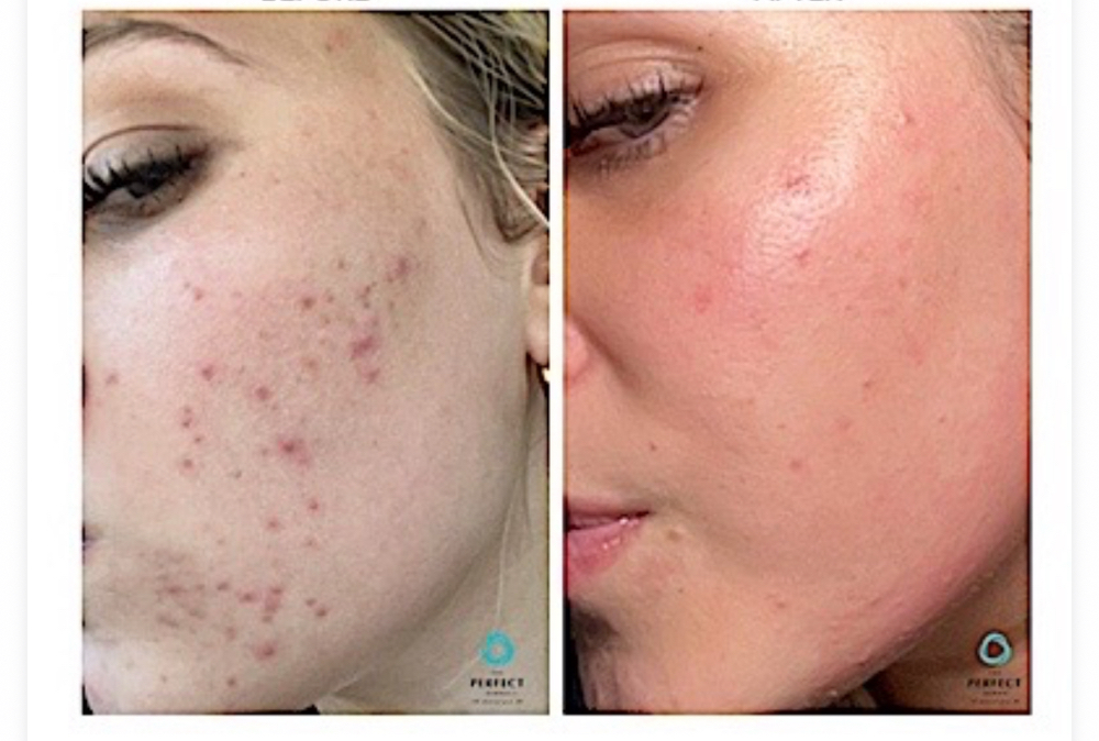 Perfect Derma Peel