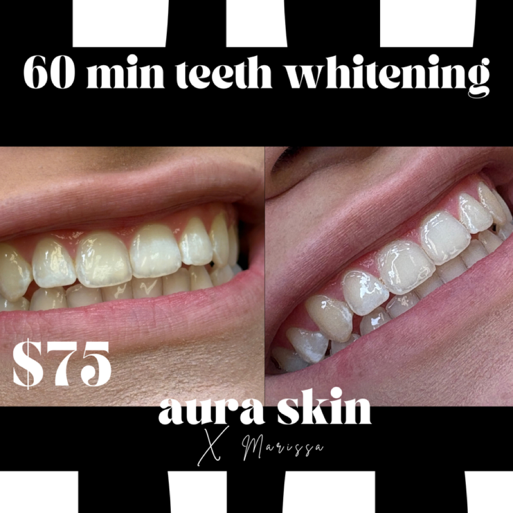February 1 HR Teeth Whitening at Aura Skin x Marissa in Alice, TX