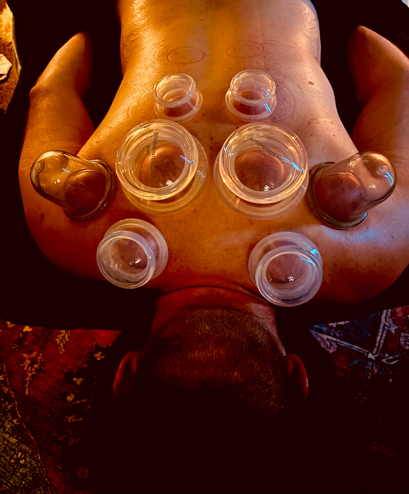 Cupping Therapy