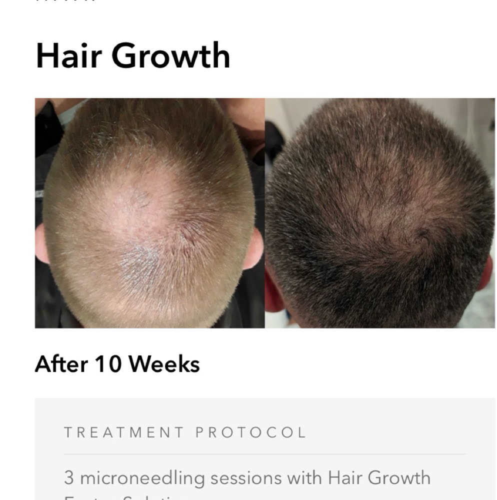 Hair Microneedle at L A BEAUTY STUDIO in Lakeway, TX