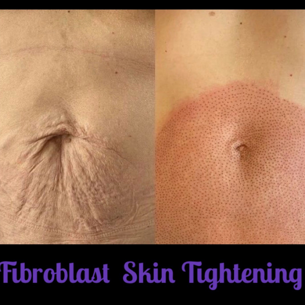Plasma Fibroblast Abdomen Area at Glo’s Beauty Creations
