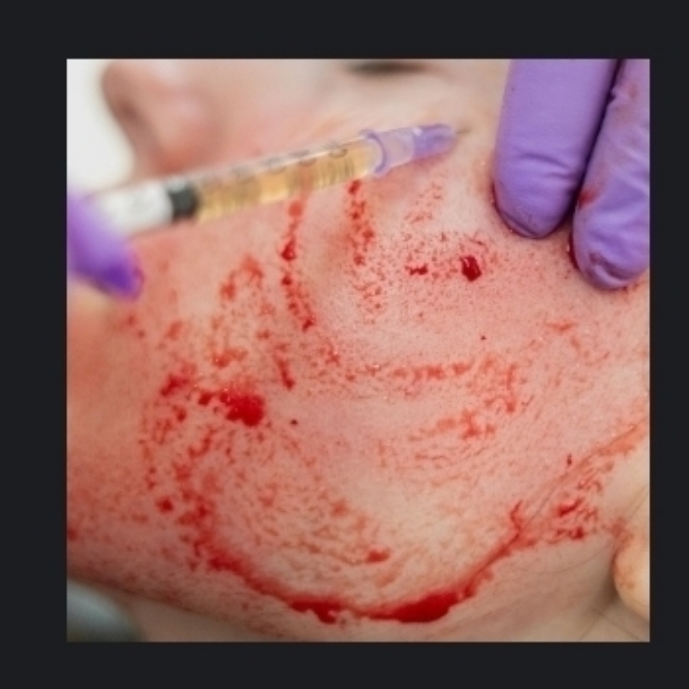 Rejuvenation with Plasma at Skin & Toxx Medical Spa Westchase in Houston, TX