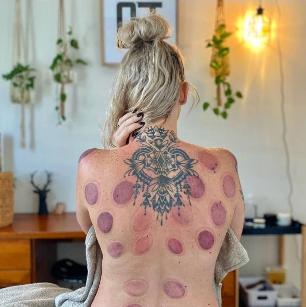 Cupping Therapy Add-on