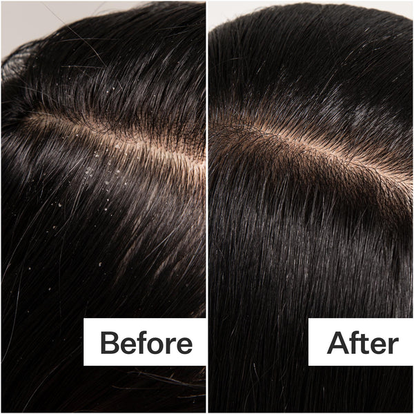 Hair scalp exfoliation
