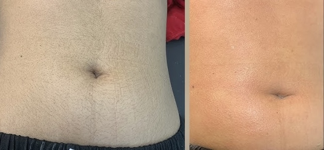 Waxing-Stomach