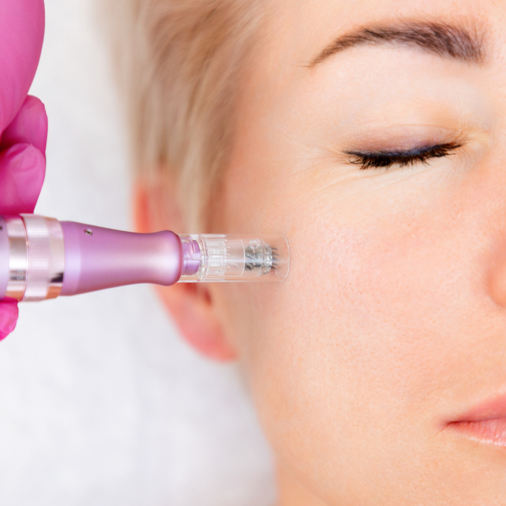 Microneedling