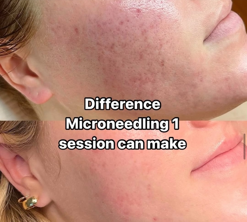 Microneedling