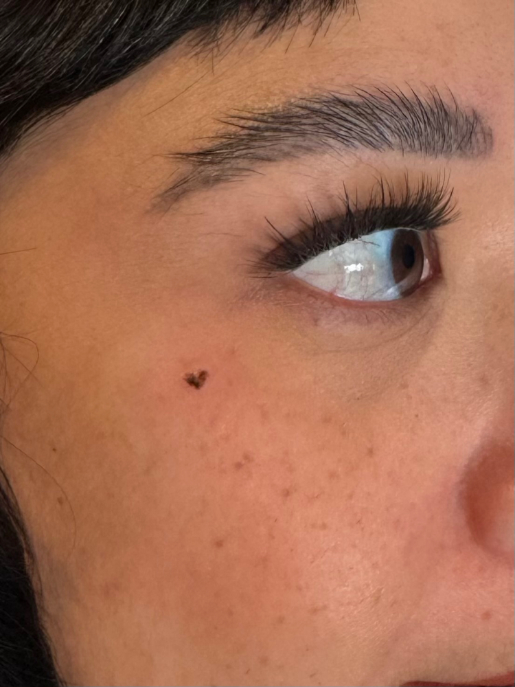 Shaped Freckles