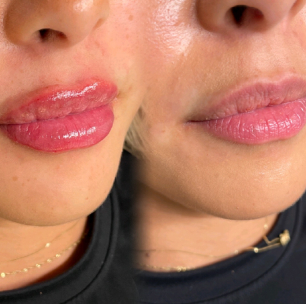 Lip Filler at Victorious Aesthetics in Crandall, TX