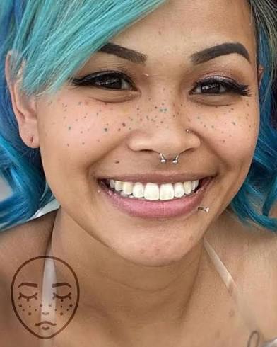 Freckling