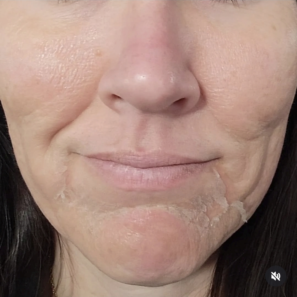 Get Glowing Micropeel