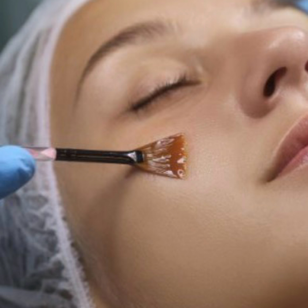 Alpine Renewal (Chemical Peel) at Alpine Glow Aesthetics, LLC in Colorado Springs, CO