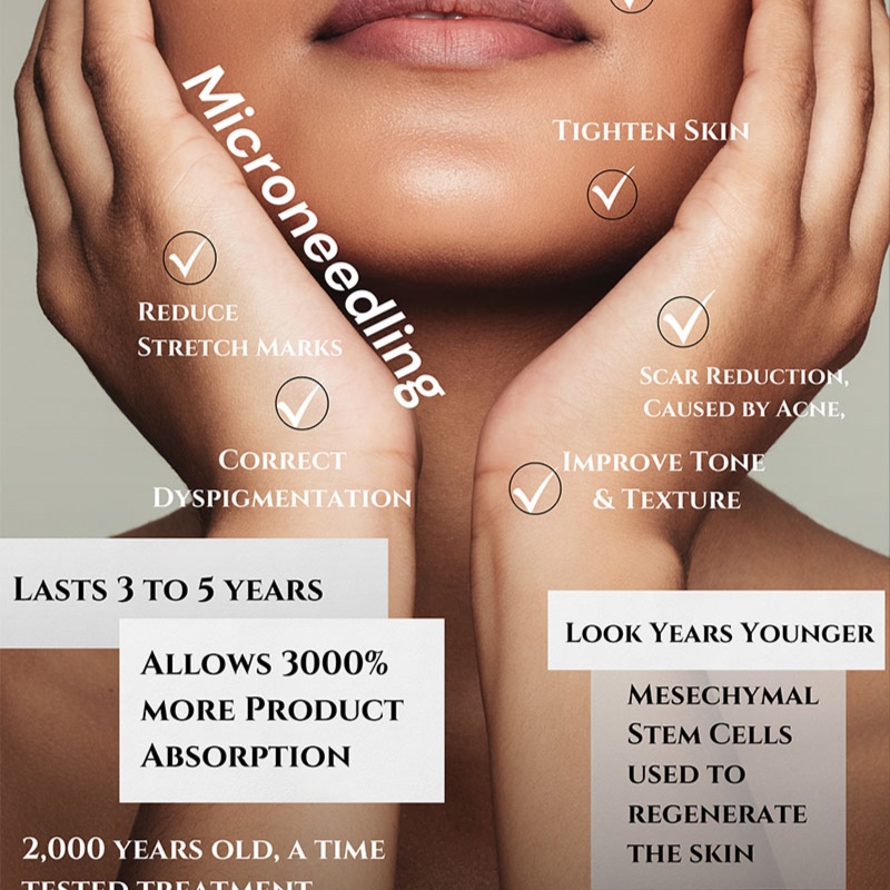 Package of 3 Microneedling at Skin Haven By Lindsey in NJ, NJ