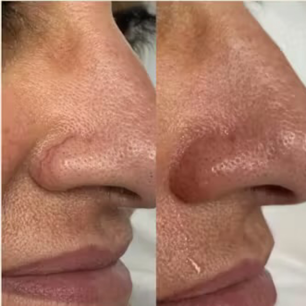 Laser Vein Removal at Cedar & Sage Aesthetics & Wellness in Hiawassee, GA