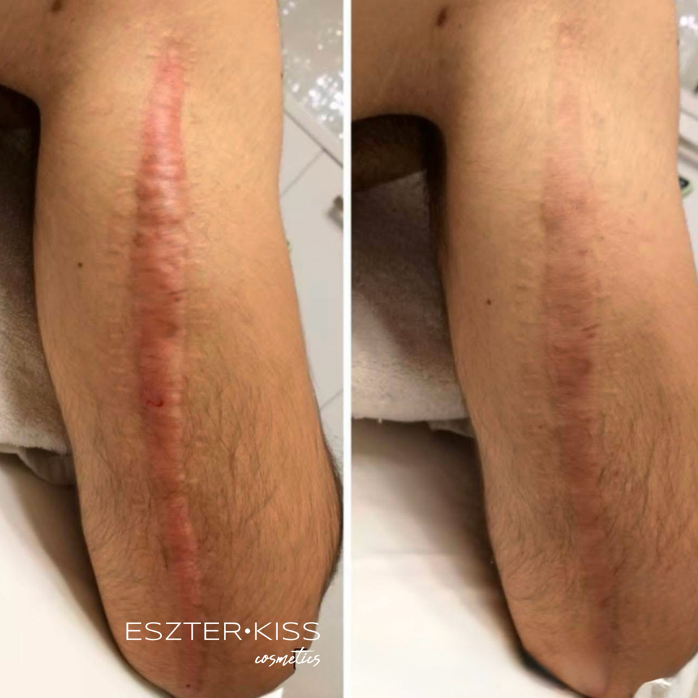 Scar Restoration- Plasma Fusion at Eszter Kiss Cosmetics in Deltona, FL