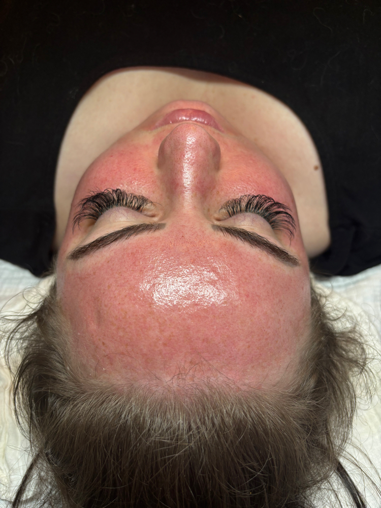Microneedling