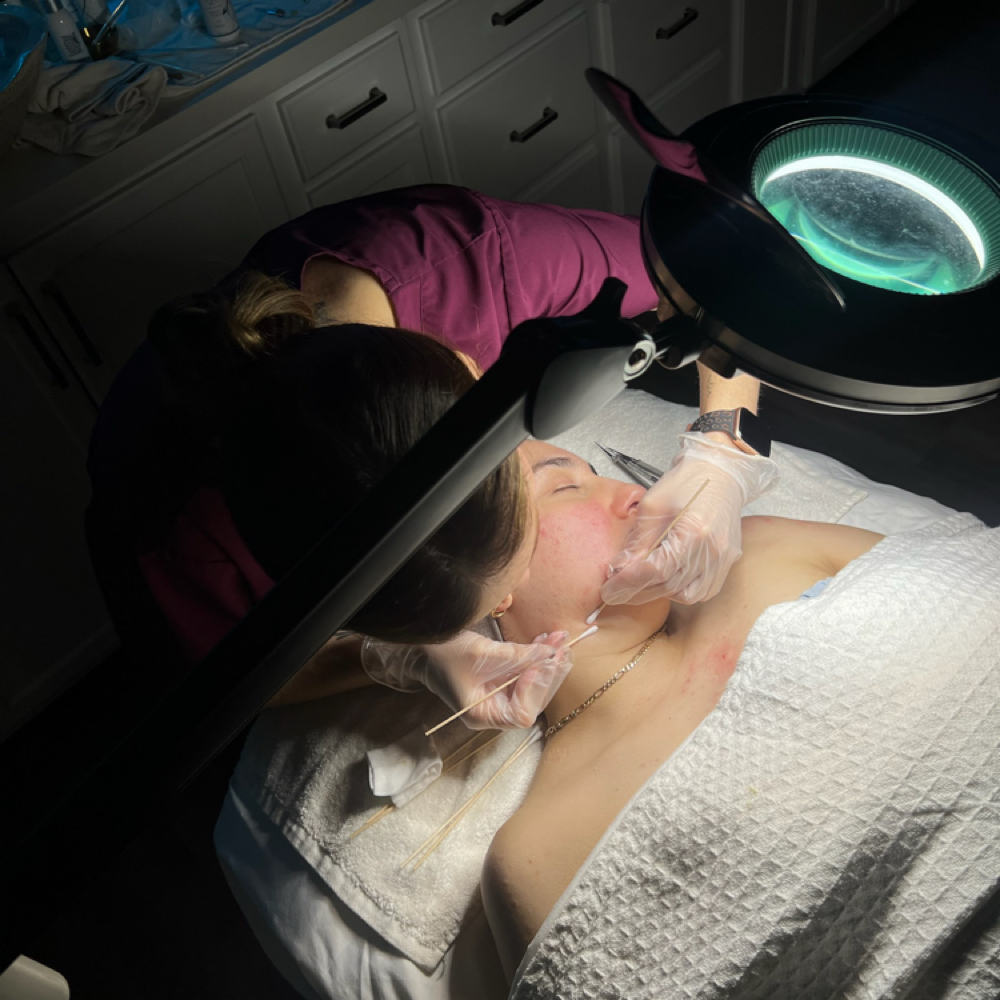 Acne Treatment at Love Yourself By Jeni in Kingwood, TX