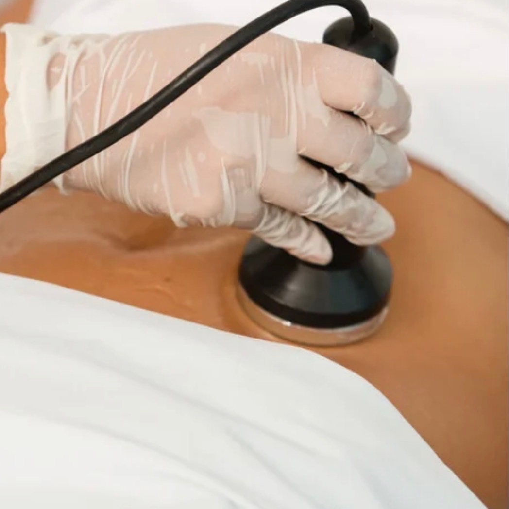 Cavitation + Rf skin tightening at Soft Life Aesthetics in Des Peres, MO
