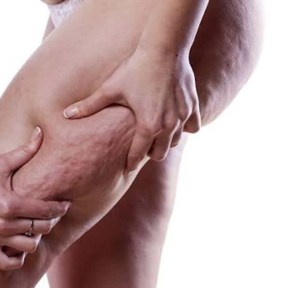 Tru Smooth Cellulite Therapy at Tru Beauty Lab LLC in El Paso, TX