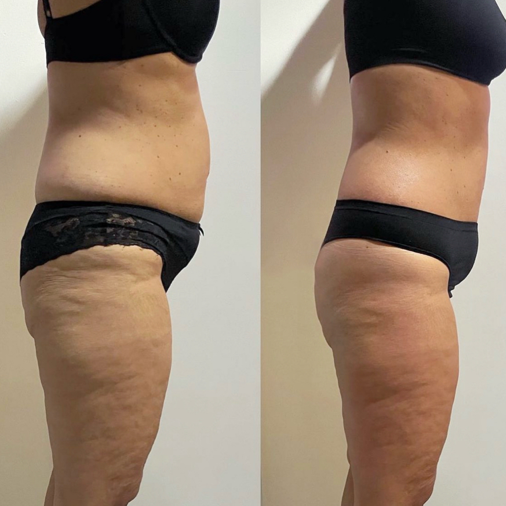 Body Slimming Wrap at Eula Skin in Dallas, TX