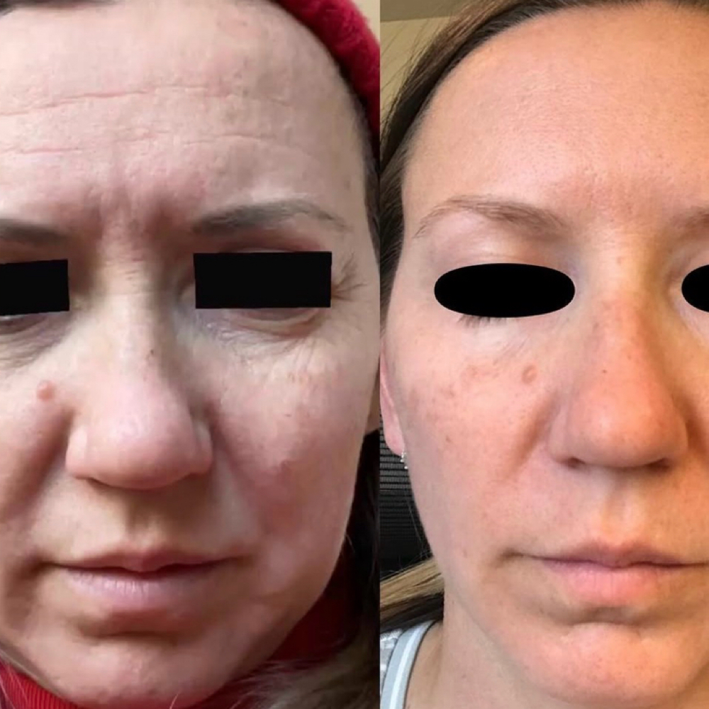 Vampire Facial: PRP at DERMÉ Med Spa (formerly LA Lash and Laser Med Spa) in Loveland, CO