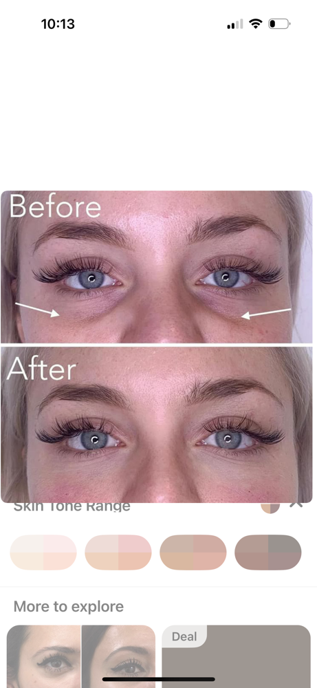 Hooded Eyes Botox