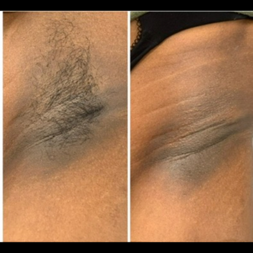 Underarms at Sweet Escape Studio in Matteson, IL