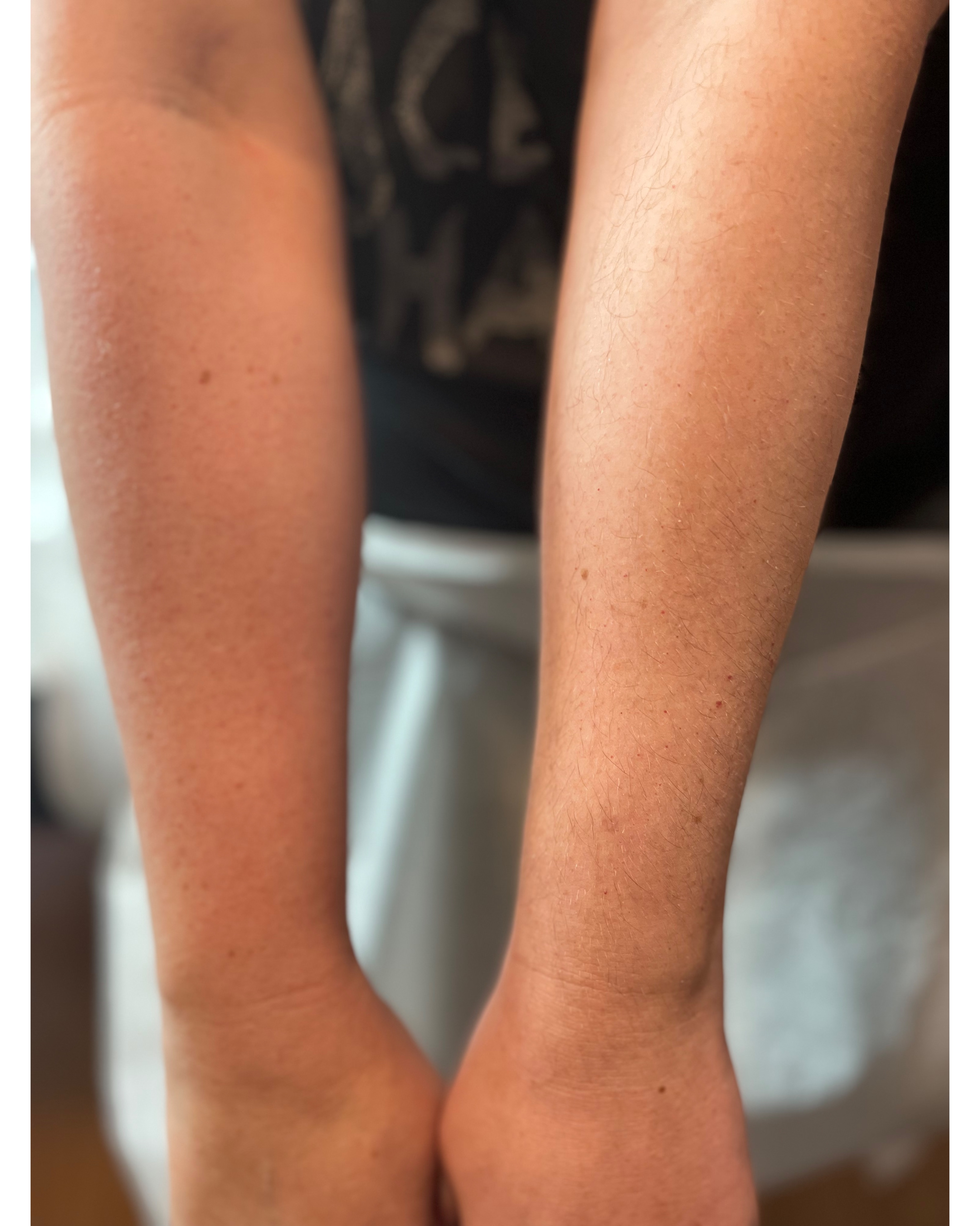 Lower arms