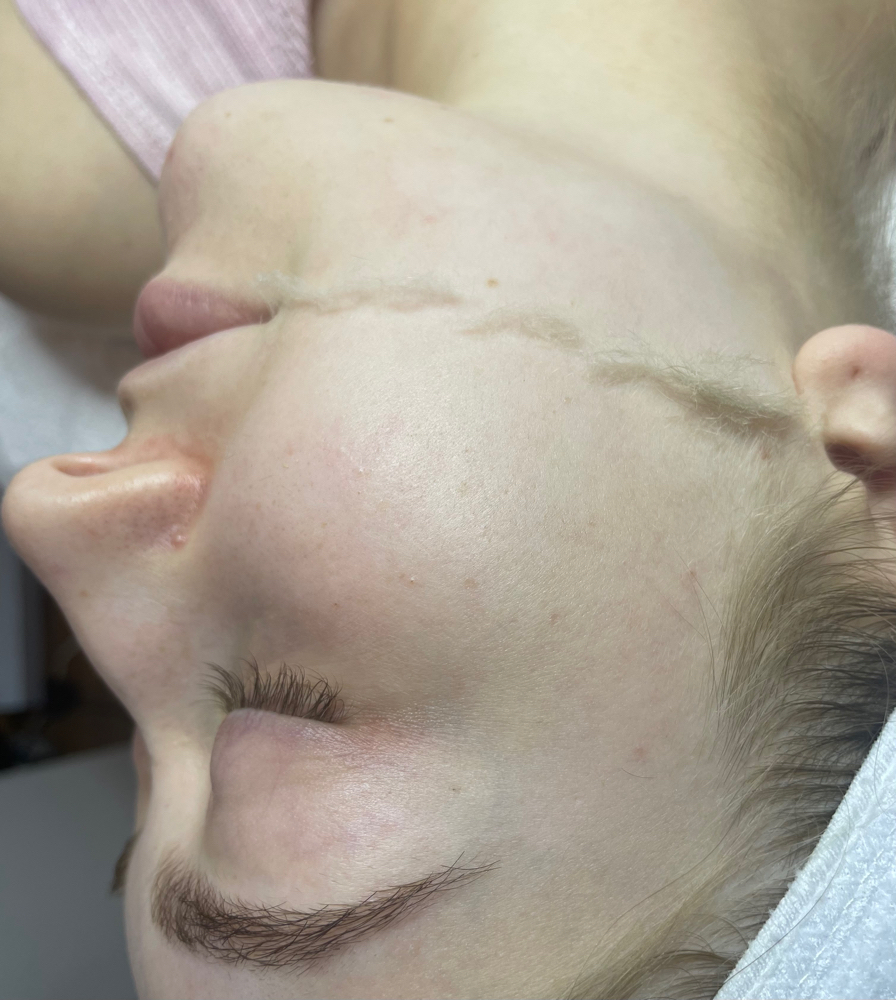 Dermaplane Facial