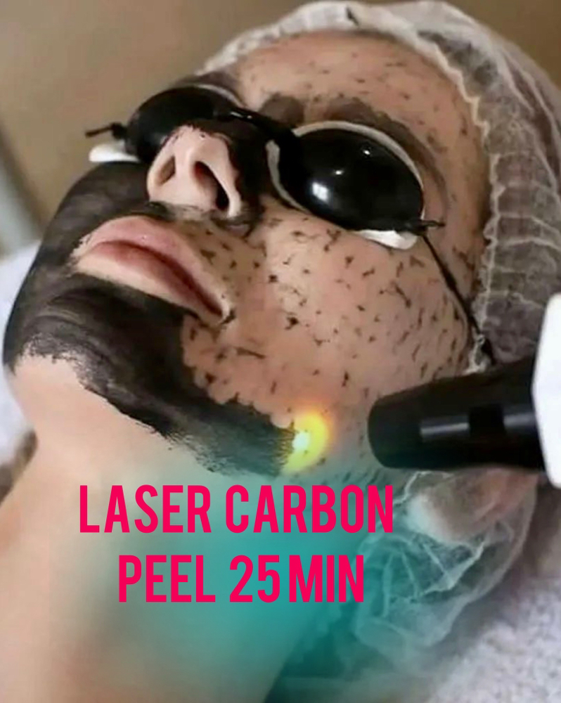 Laser Carbon Peel 25 min