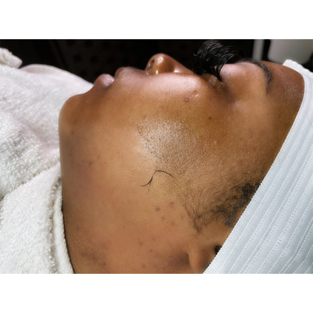 Dermaplane
