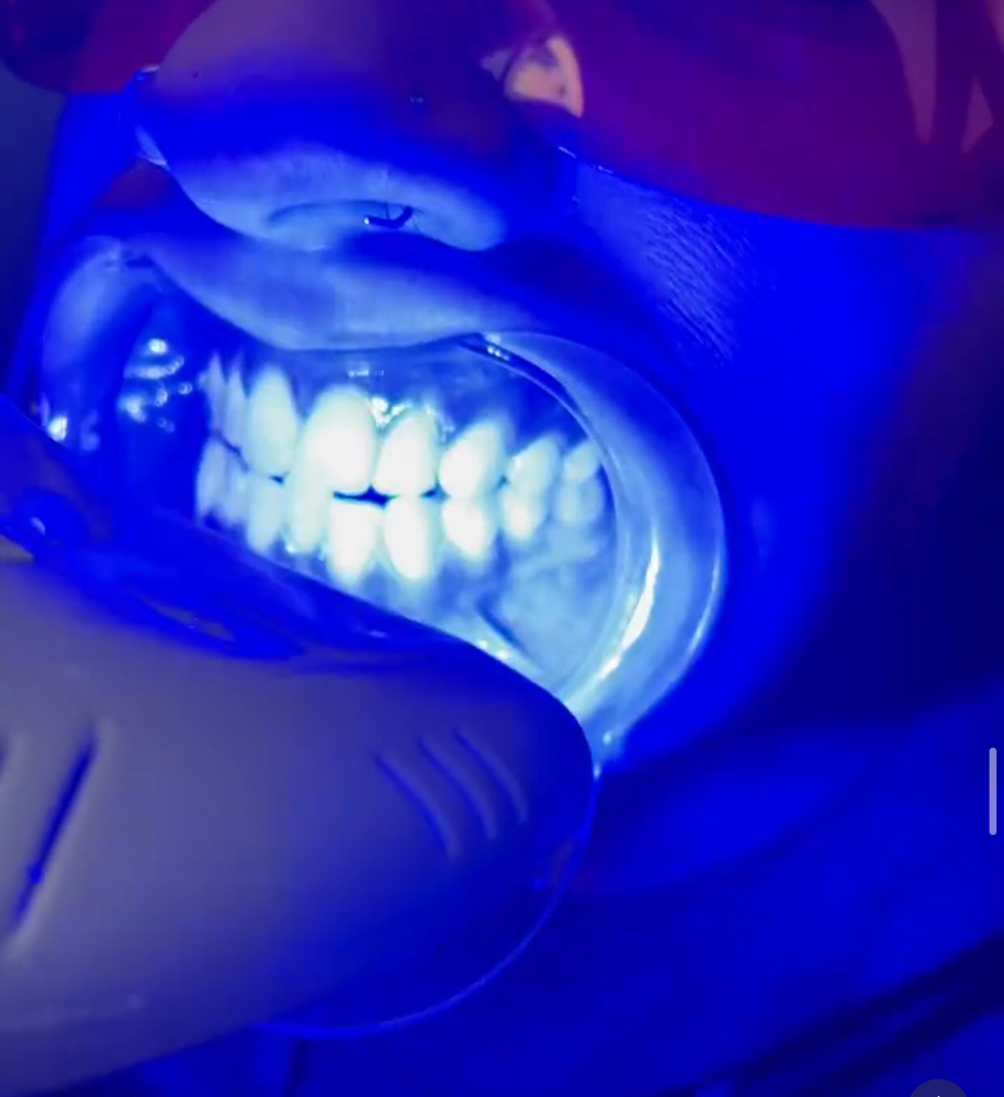 Best Delux Teeth Whitening