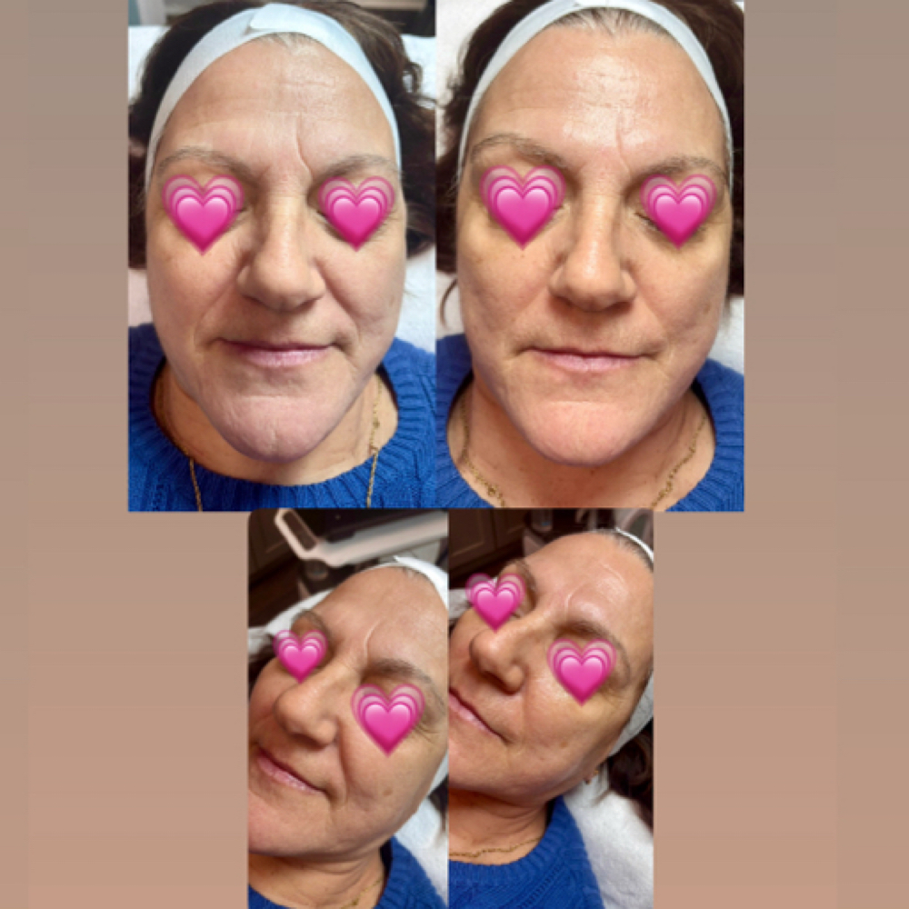 Laser Glow Facial at Soul Aura in Indian Orchard, MA