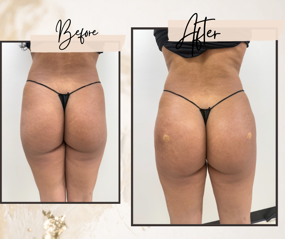 Liquid BBL  (Butt & Hip fillers)