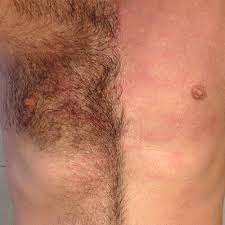 Waxing - Chest