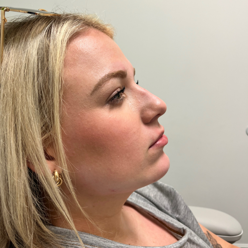 Liquid Rhinoplasty at Genesis Health and Beauty Bar in Daphne, AL