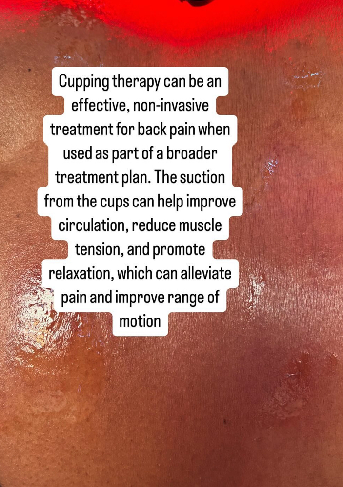 Back Pain Cupping