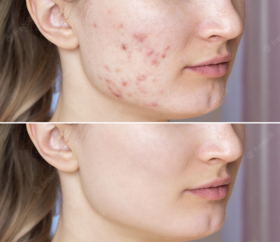 Bye Bye Acne Program Consultation