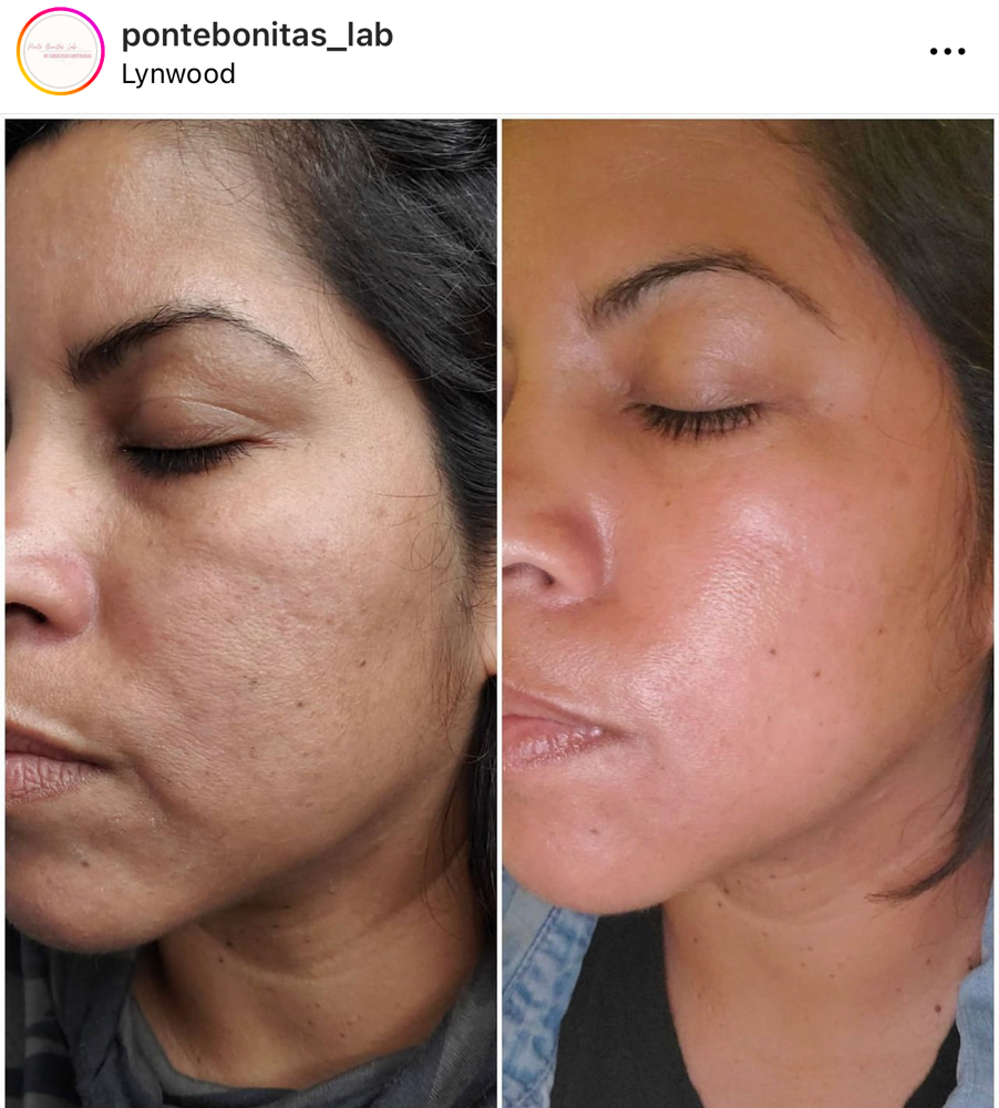 Microneedling 6 Session